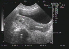 懷孕8個(gè)月b超圖分析 8個(gè)月彩超圖